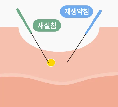 STEP 01 — 회복새살침 테라피 원리