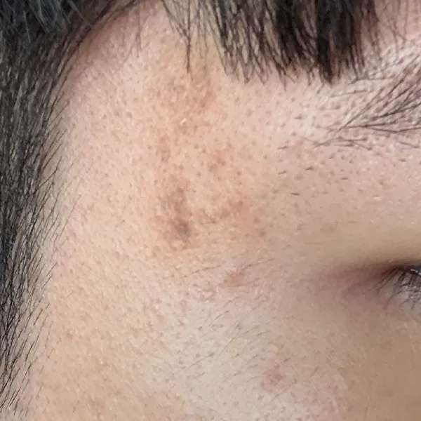 시술 후 1일차