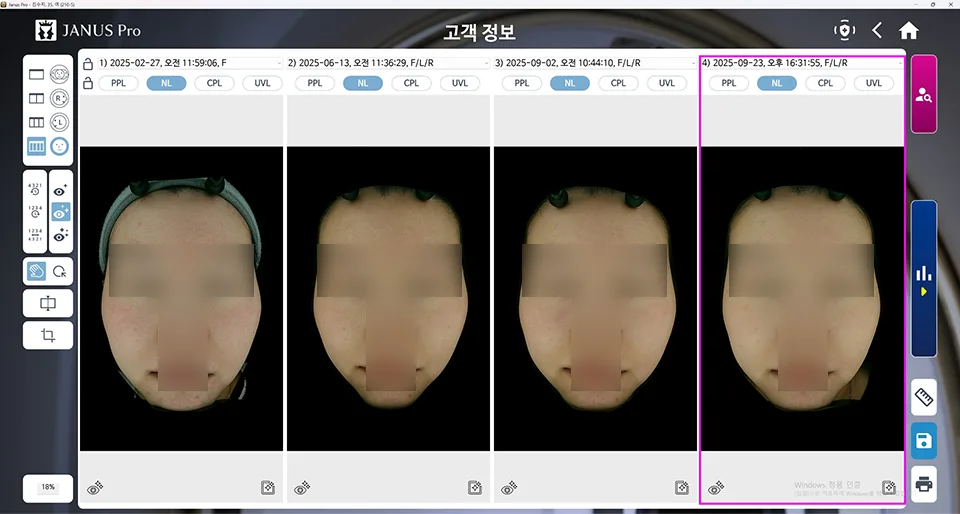 모공 컨택터 10회