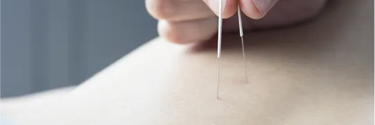 한방 바디 케어 침 시술 장면