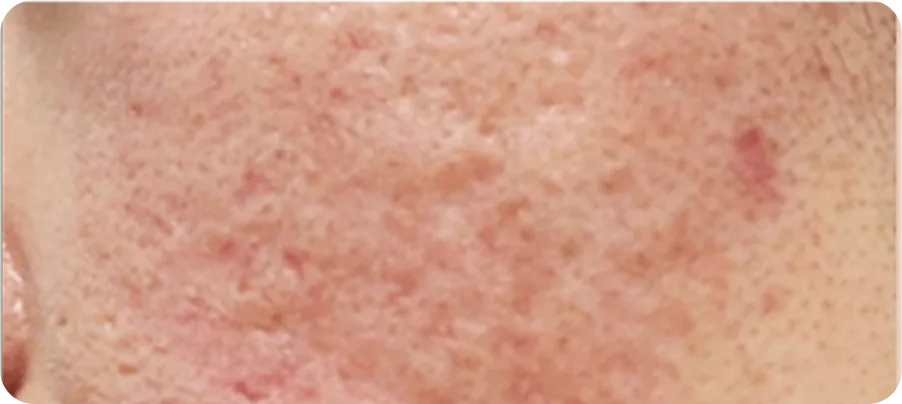볼 여드름 패인 흉터