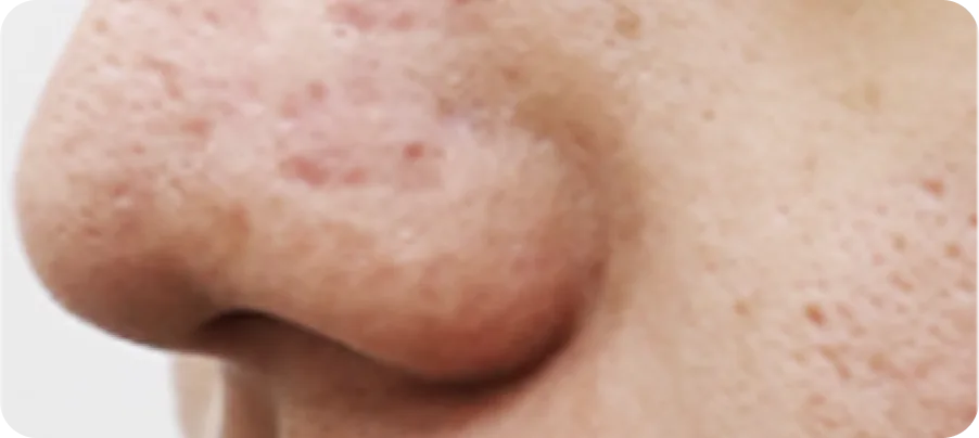 코, 인중 여드름 패인 흉터